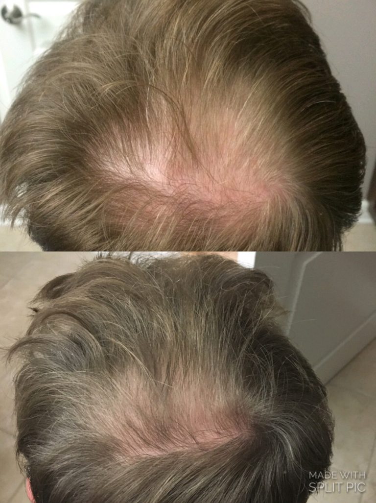 Chad hair loss before after top Eastside Skin Care
