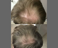 Platelet Rich Plasm for Hair Loss