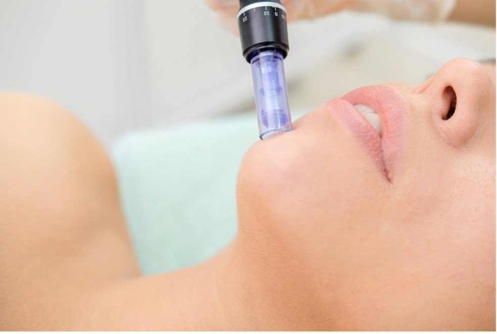 eastside skin care and laser center microneedling with sculptra