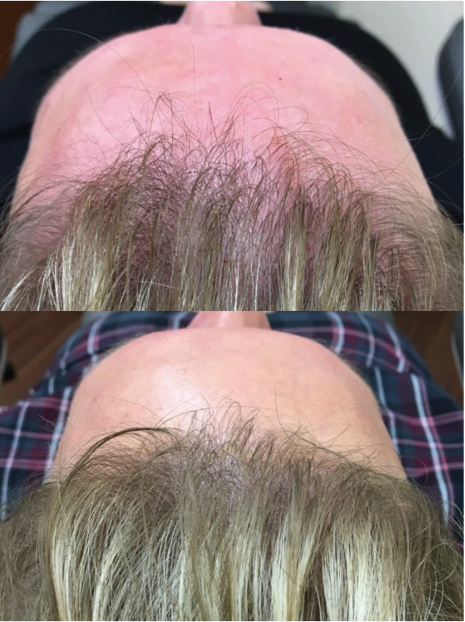 before-after-prp-for-hair-loss