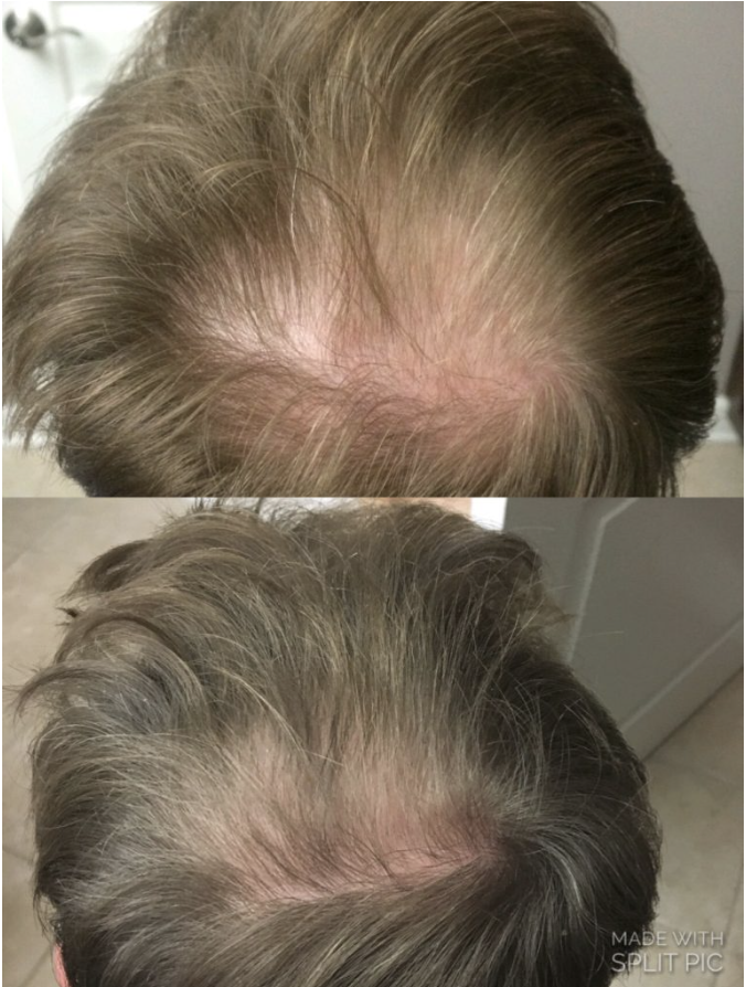 before-after-prp-for-hair-loss